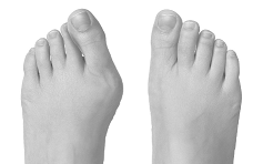Pomůcky na hallux/vbočený palec